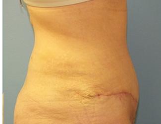 Tummy Tuck Before & After Patient #8191