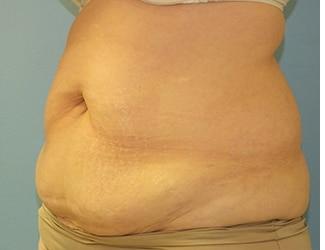 Tummy Tuck Before & After Patient #8191