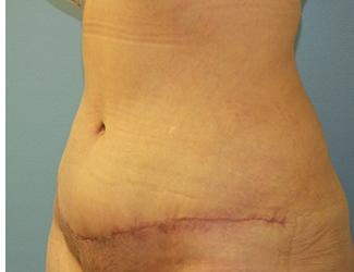 Tummy Tuck Before & After Patient #8191