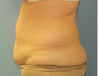 Tummy Tuck Before & After Patient #8191
