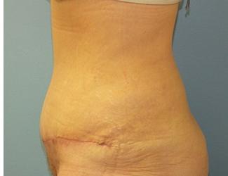 Tummy Tuck Before & After Patient #8191