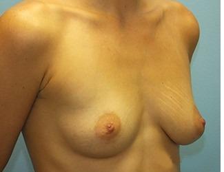 Breast Augmentation Before & After Patient #8246