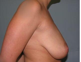 Breast Lift/Mastopexy Before & After Patient #8369