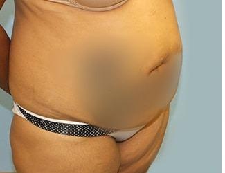 Tummy Tuck Before & After Patient #8199
