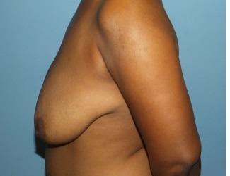 Breast Reduction Before & After Patient #8419