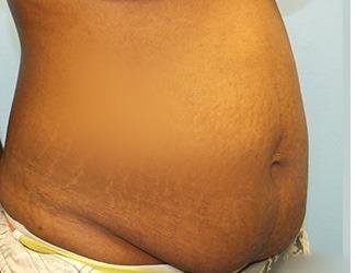 Tummy Tuck Before & After Patient #8195