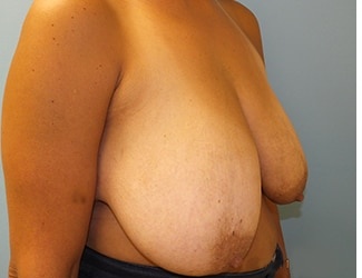 Breast Reduction Before & After Patient #8410