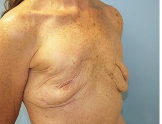 Breast Revision Before & After Patient #8240