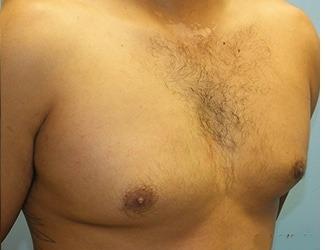 Gynecomastia Before & After Patient #8441
