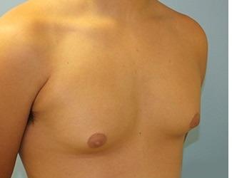 Gynecomastia Before & After Patient #8439