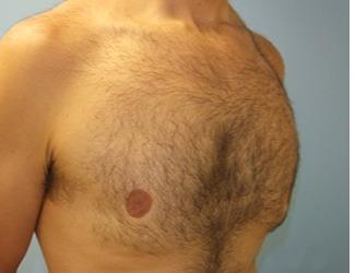 Gynecomastia Before & After Patient #8435
