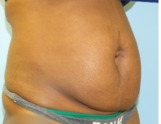 Tummy Tuck Before & After Patient #8192