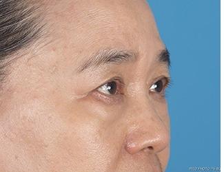 Browlift Before & After Patient #8460