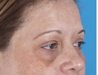 Browlift Before & After Patient #8458