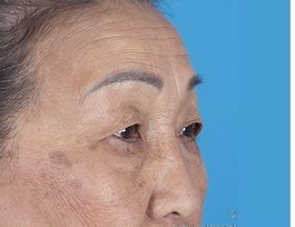 Browlift Before & After Patient #8457