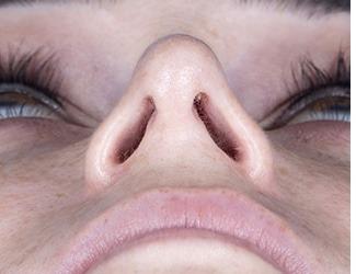 Rhinoplasty Before & After Patient #8808