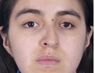 Rhinoplasty Before & After Patient #8807