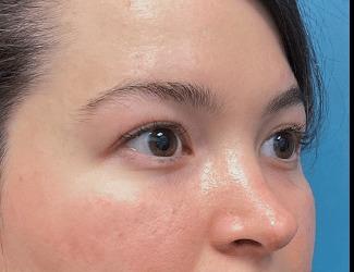 Blepharoplasty Before & After Patient #8485