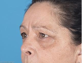 Blepharoplasty Before & After Patient #8484