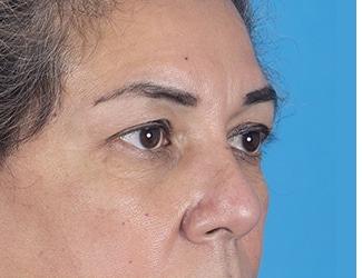 Blepharoplasty Before & After Patient #8482