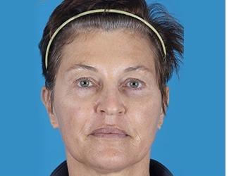 Blepharoplasty Before & After Patient #8480