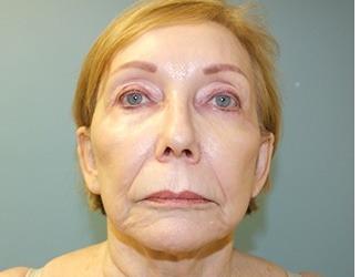 Lip Lift Before & After Patient #8800