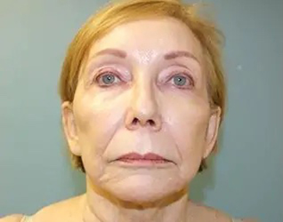 Lip Lift Before & After Patient #8800