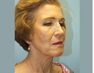 Facial Fat Grafting Before & After Patient #8745
