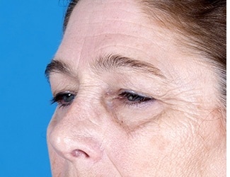 Facial Fat Grafting Before & After Patient #8748