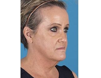 Facial Fat Grafting Before & After Patient #8741