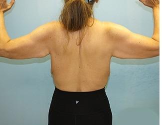 Arm Lift Before & After Patient #4690