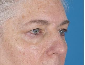 Facial Fat Grafting Before & After Patient #8744