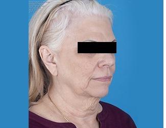 Facial Fat Grafting Before & After Patient #8740