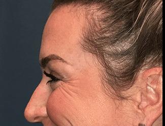 Botox Before & After Patient #8821