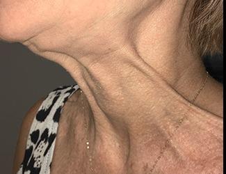 Botox Before & After Patient #8820