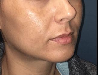 Jeuvederm Before & After Patient #8824