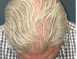 NeoGraft Before & After Patient #8826