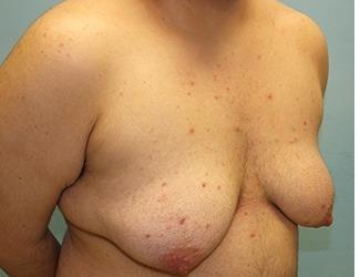Female to Male Before & After Patient #8442