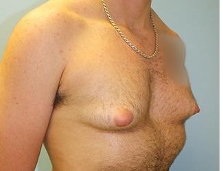 Female to Male Before & After Patient #8440