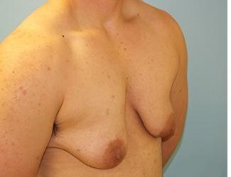 Female to Male Before & After Patient #8444