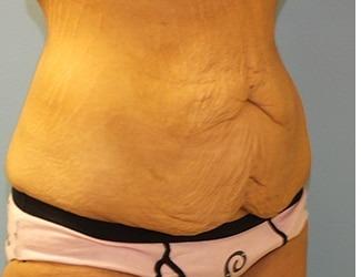 Tummy Tuck Before & After Patient #8197