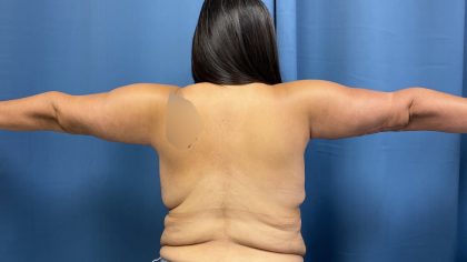 Arm Lift Before & After Patient #4856