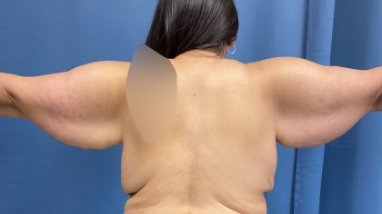 Arm Lift Before & After Patient #4856