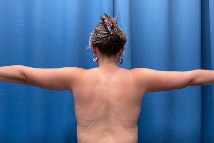 Arm Lift Before & After Patient #4839