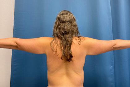 Arm Lift Before & After Patient #4839