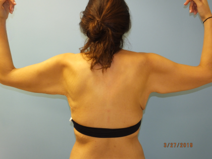 Arm Lift Before & After Patient #4821