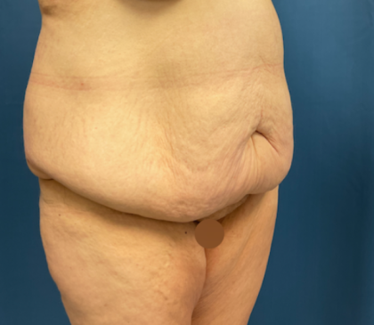 Lower Body Lift Before & After Patient #8028