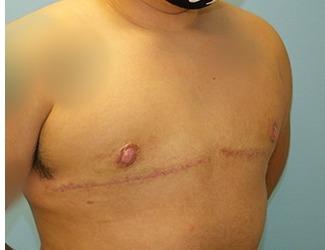 Female to Male Before & After Patient #8438
