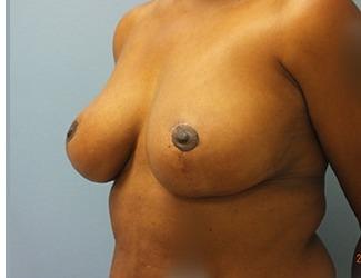 Breast Reduction Before & After Patient #8416