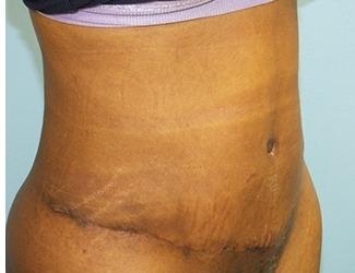 Tummy Tuck Before & After Patient #8195